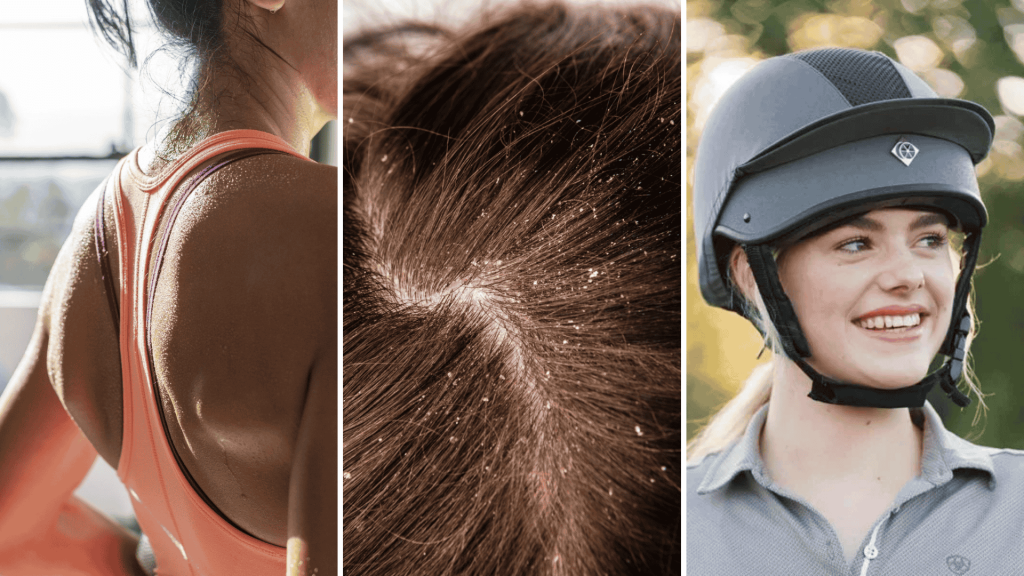 Causes Of Scalp Pimples image