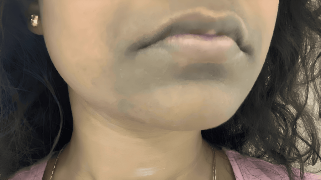 Causes of Hyperpigmentation Around Mouth