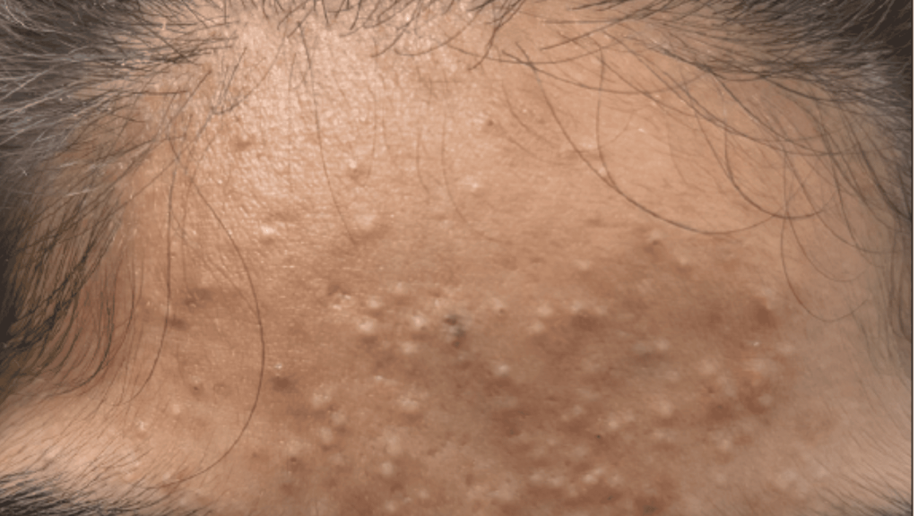 Comedonal forhead Acne img