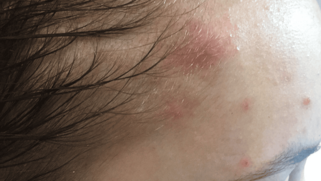 Cystic Acne img