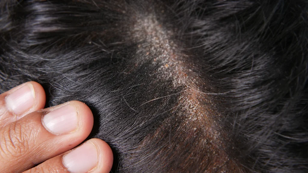 Dry scalp article