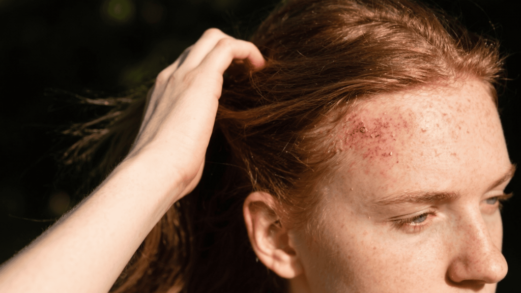 Eczema and sensitive scalp