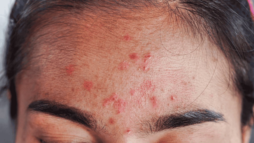Hormonal forhead Acne img