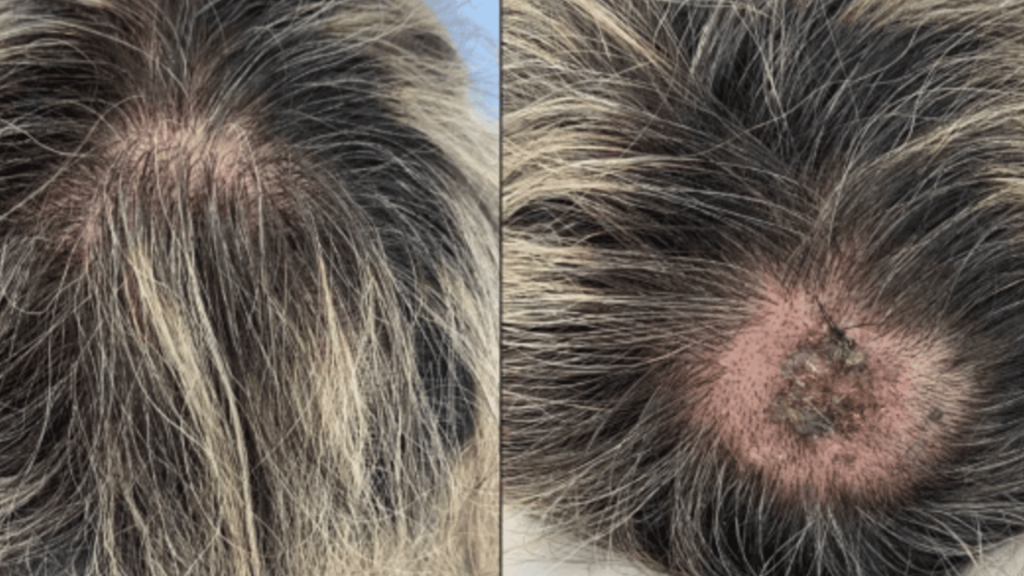 Melanoma sclap cancer