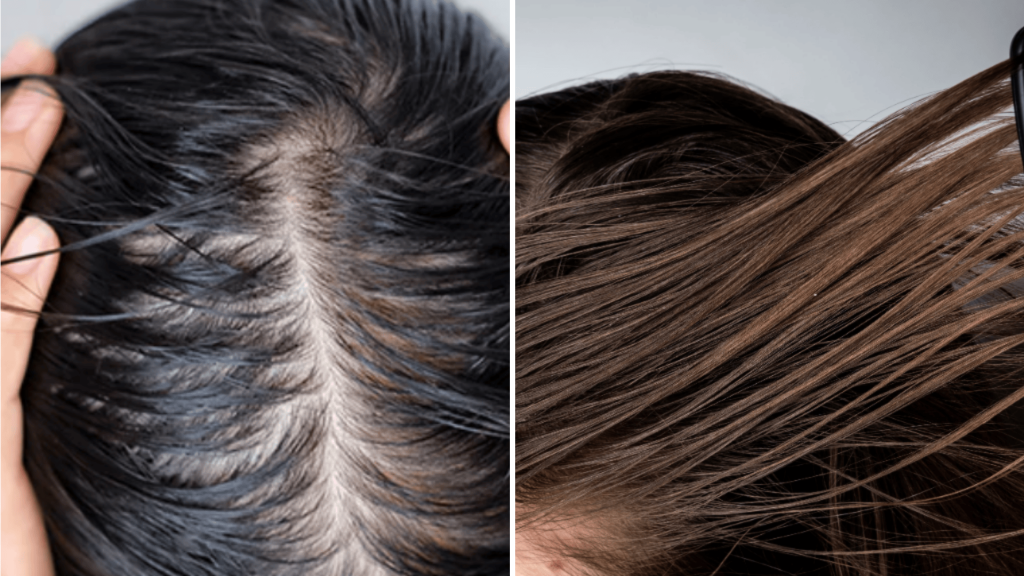 Oily Scalp vs Oily Hair