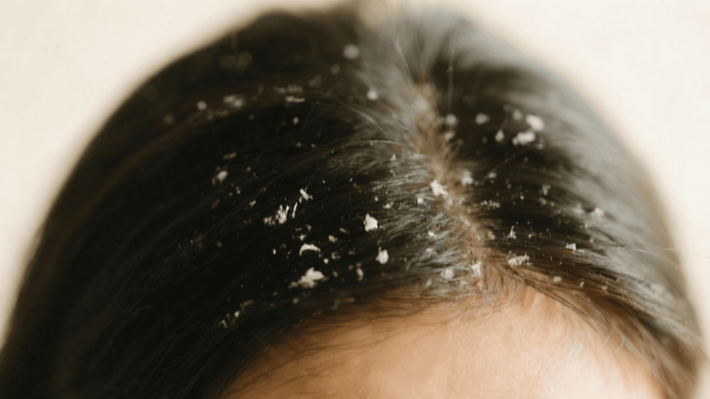 Psoriasis and seborrheic dermatitis