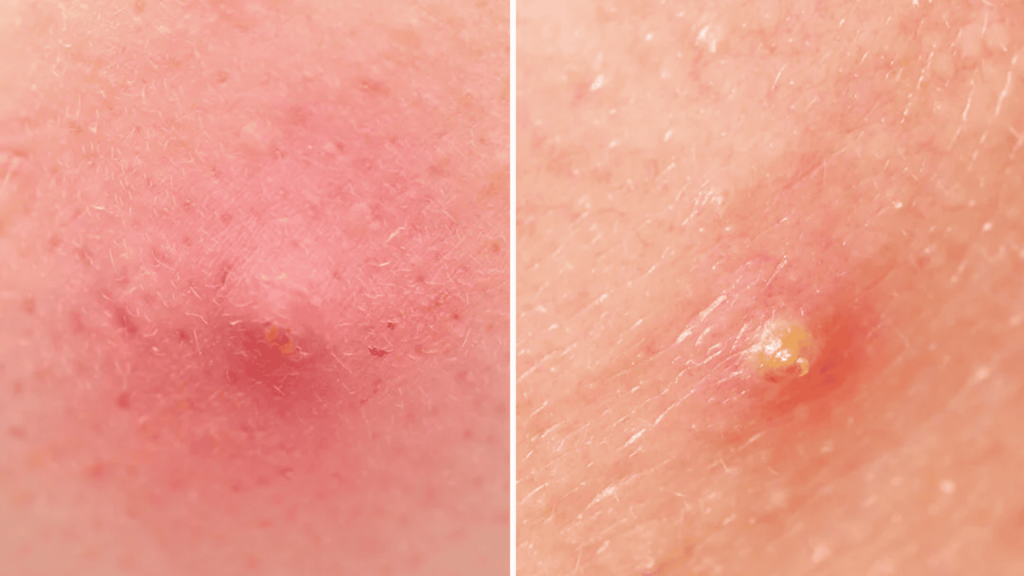 Pustules and Papules Forehead Acne