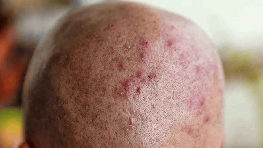Scalp Pimples and Scalp Acne