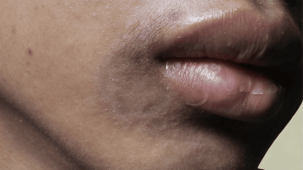 hyperpigmentation around mouth
