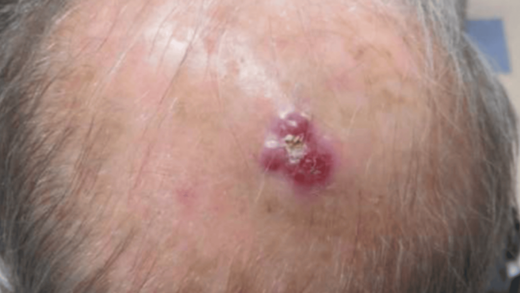 merkel cell carcinoma
