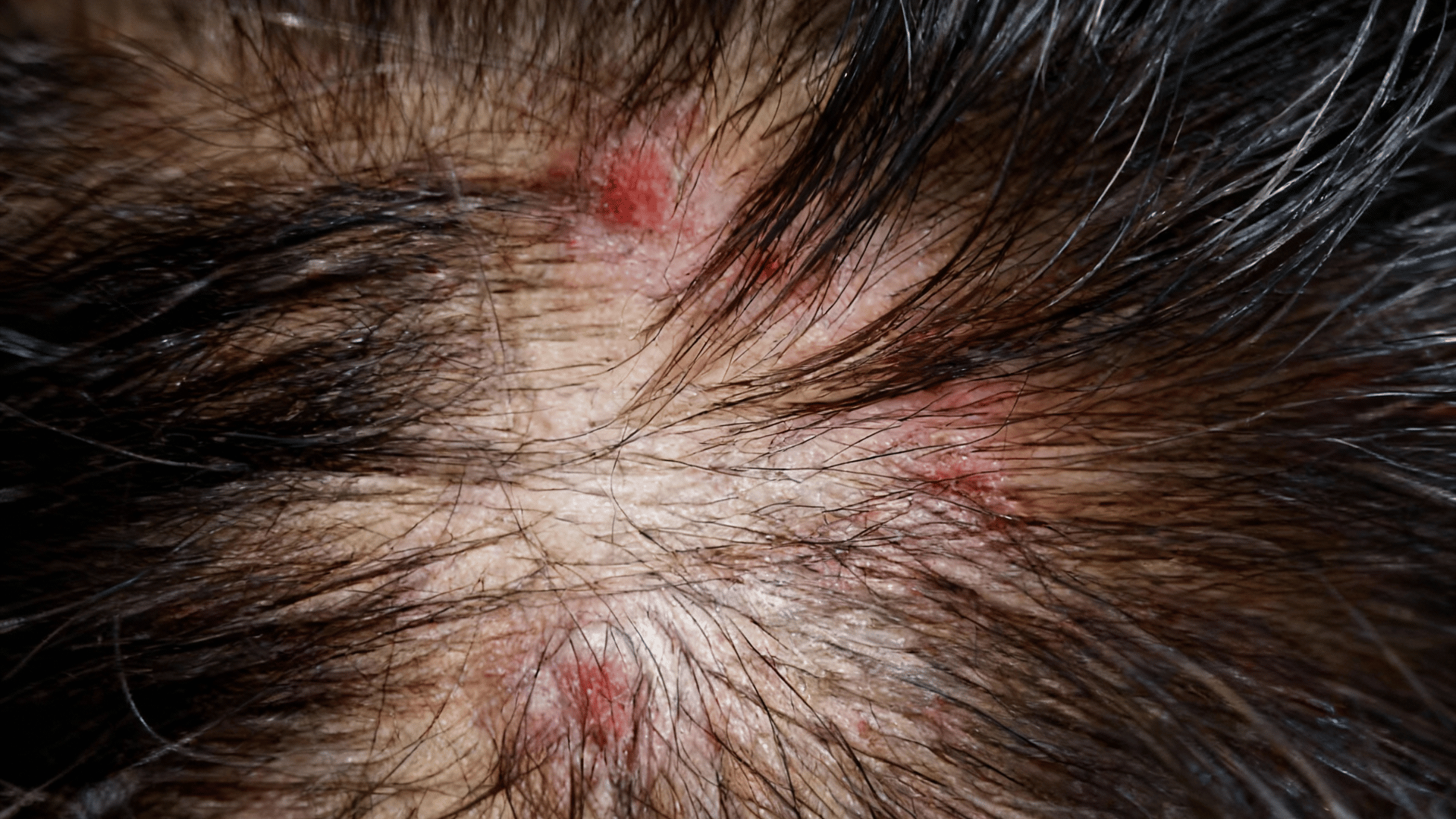 recurring scab on scalp in same spot explained