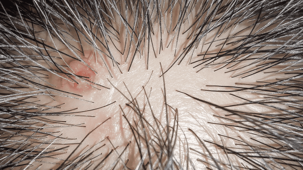 scalp folliculitis