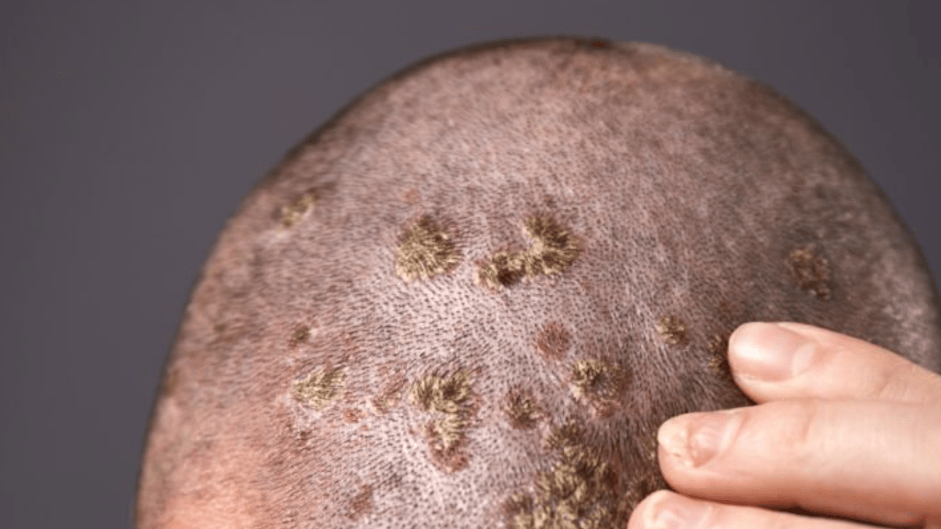 scalp fungus featured image