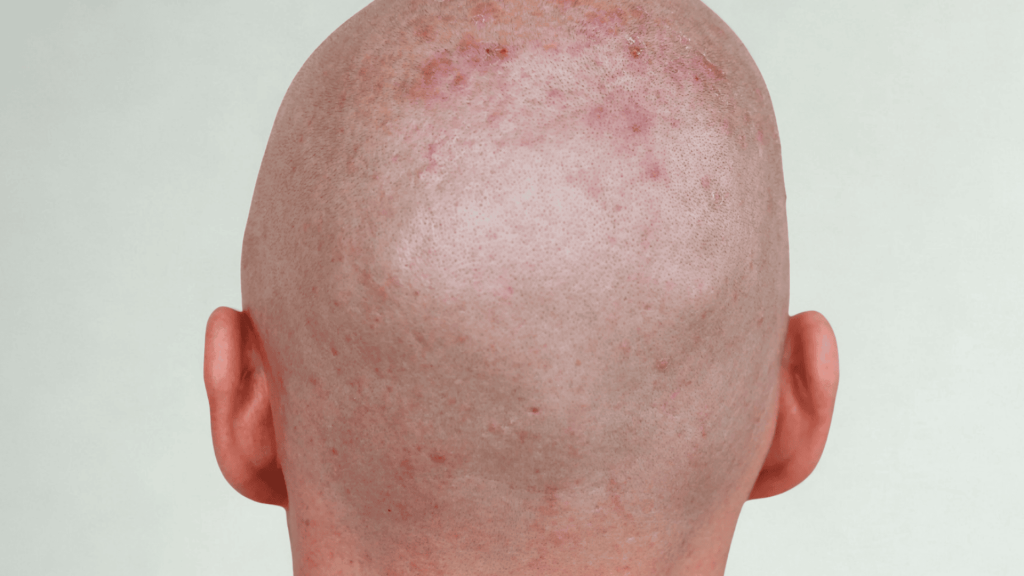 scalp pimples