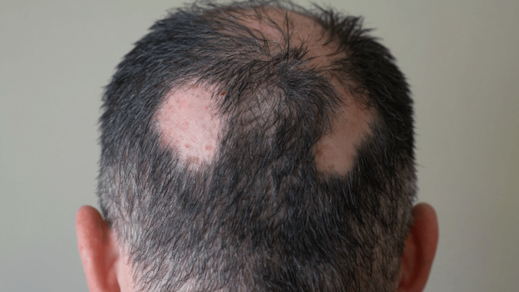 scarring alopecia