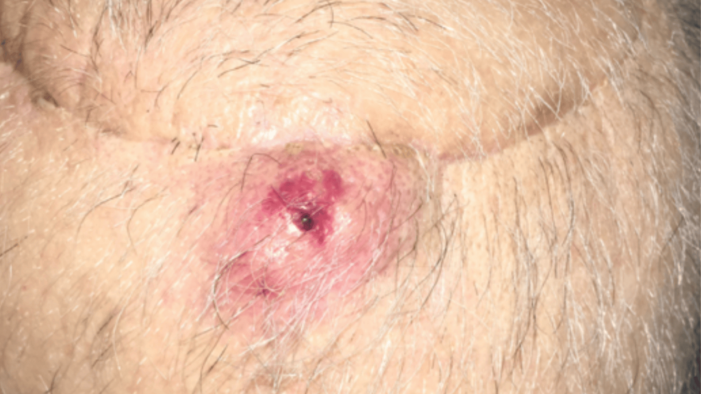 squamous cell carcinoma